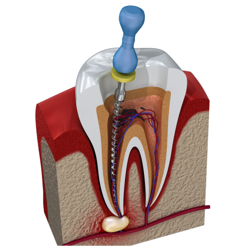 Endodoncia