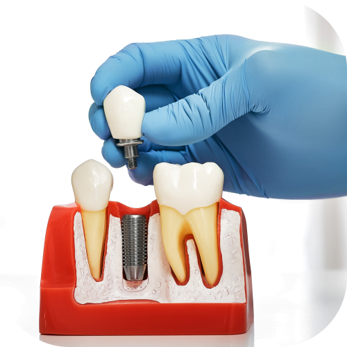 Implantes